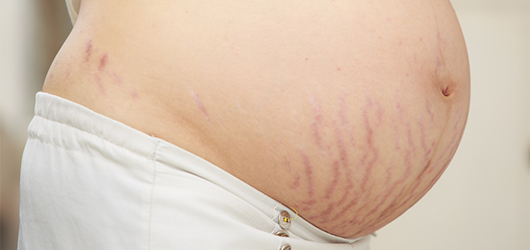できてしまった妊娠線……セルフケアで改善できるの？