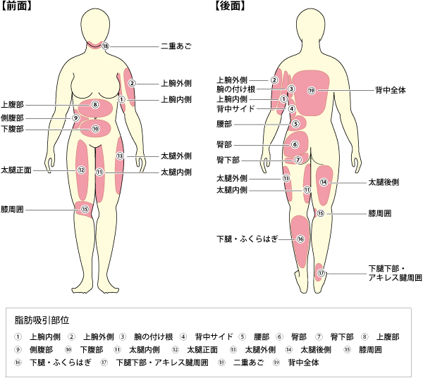 ボディジェット脂肪吸引適応部位
