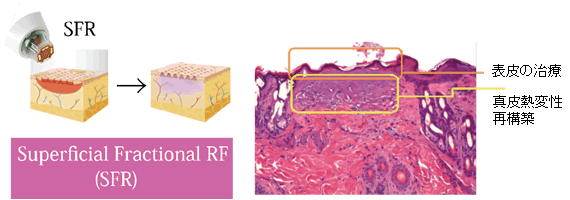 フラクショナルRF治療