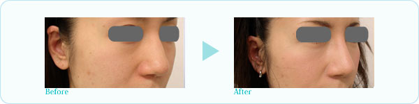 隆鼻プロテーゼ症例写真2