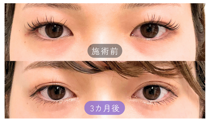目頭切開症例