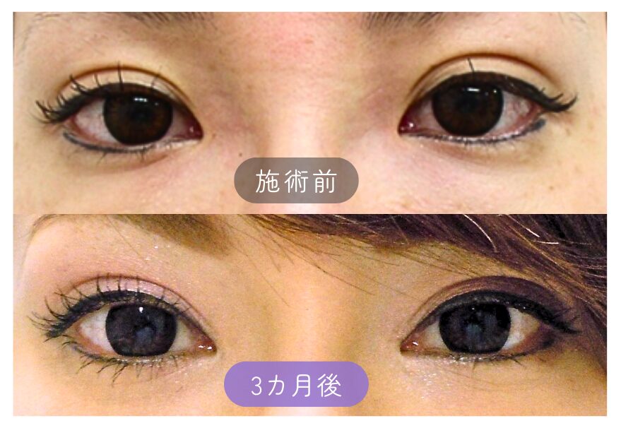 目頭切開症例