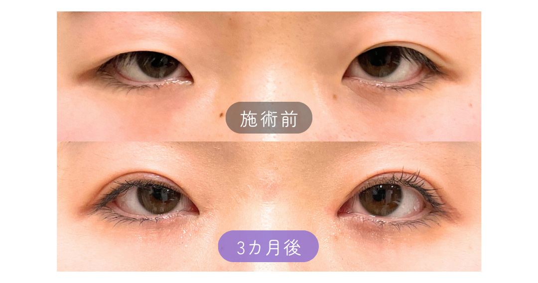 全切開+目頭切開症例