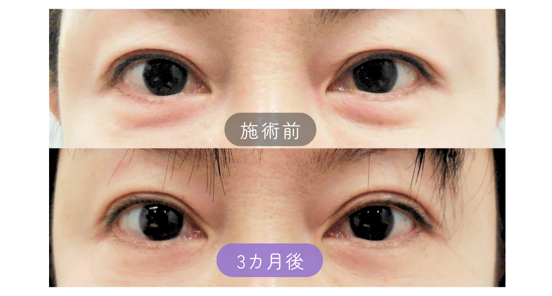 二重ラインでのたるみ取り切開症例