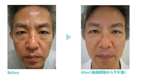 スーパーテノール院長実体験